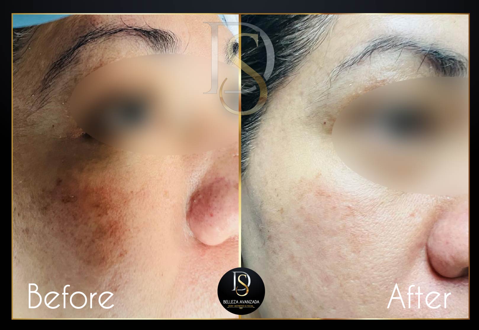 Before and after pigmentation treatment