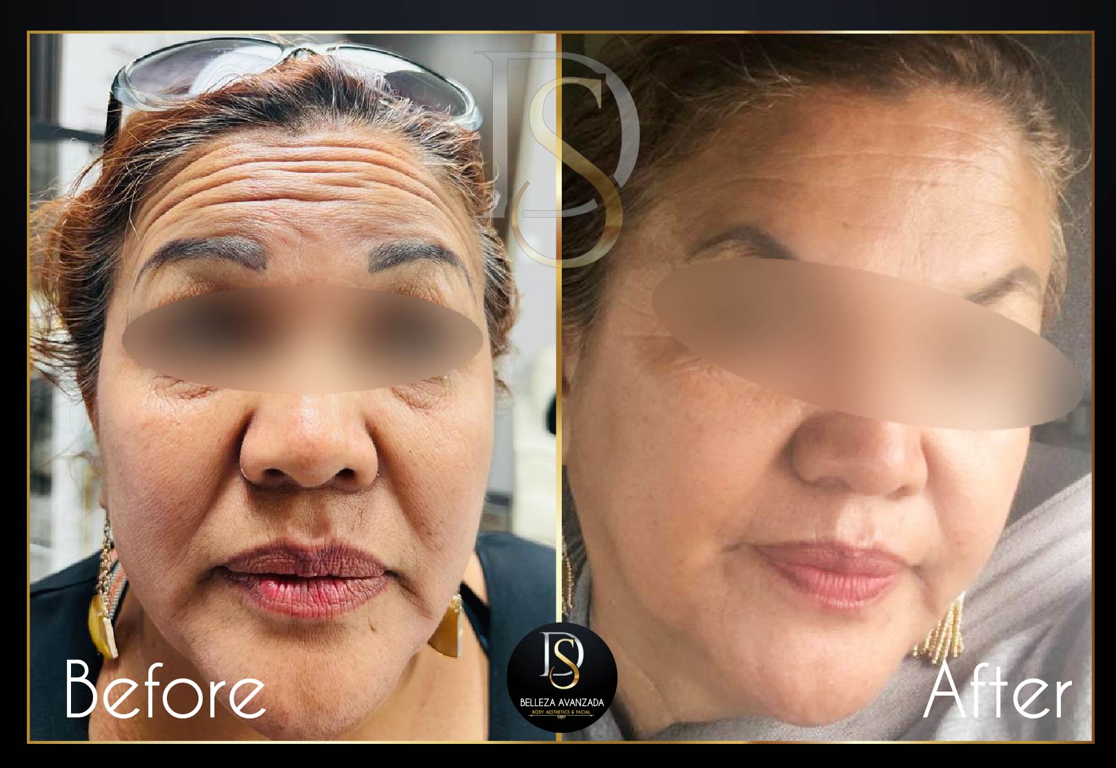 Before and after HIFU facelift