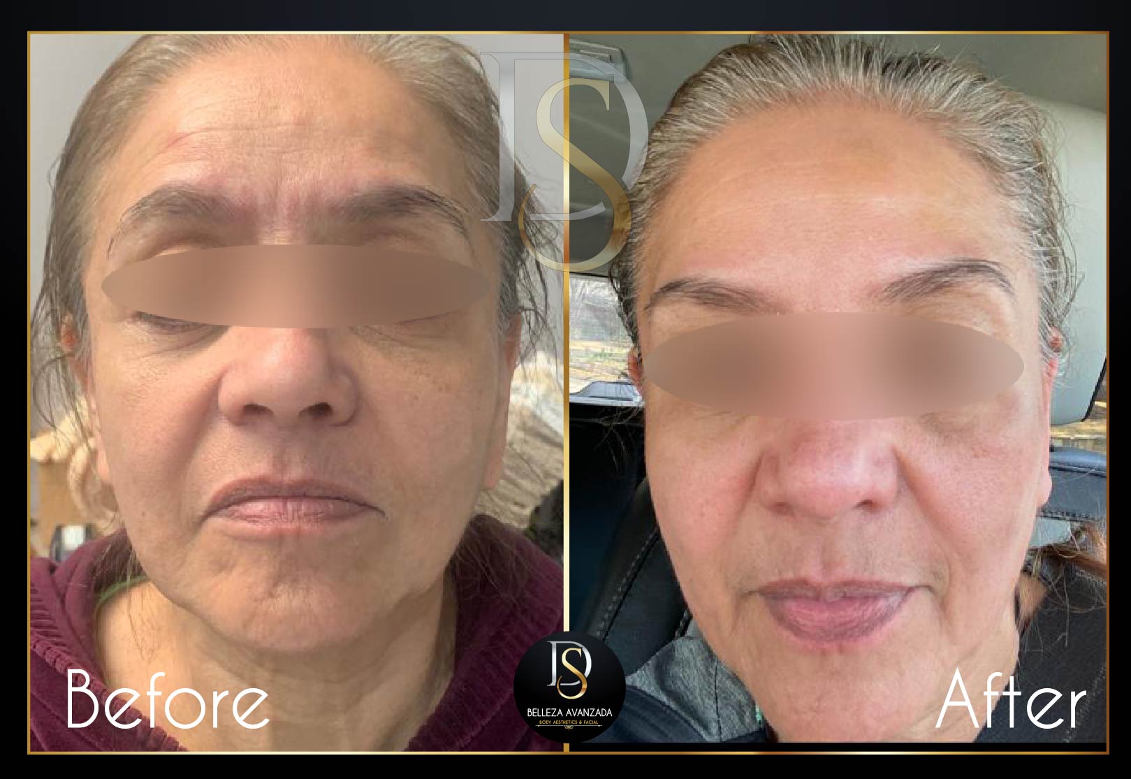 Before and after anti-aging treatment