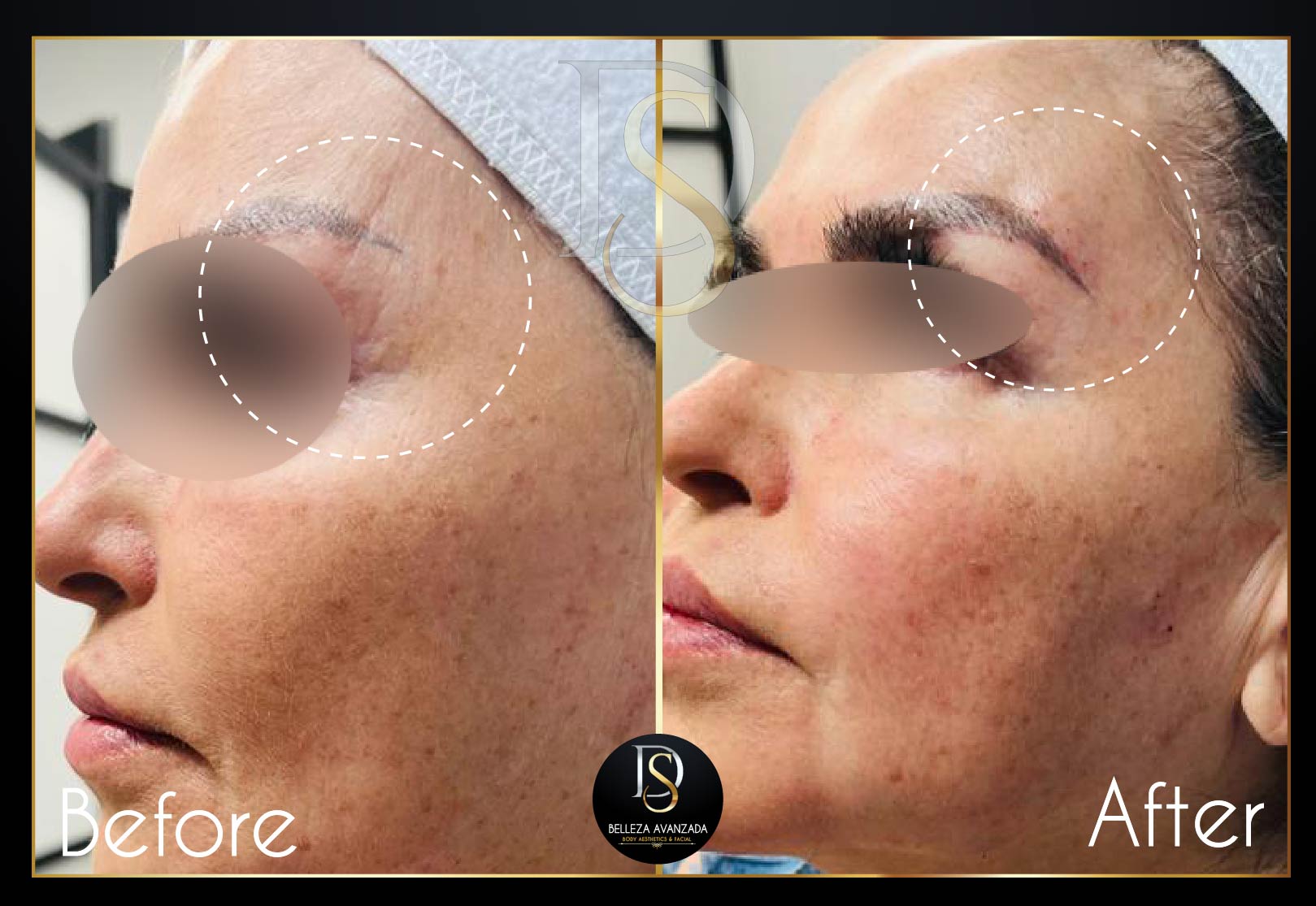 Before and after skin rejuvenation