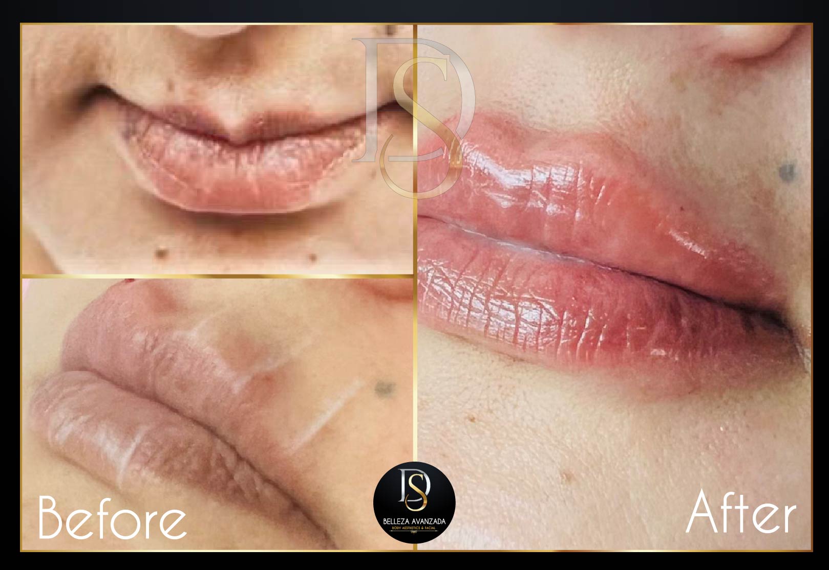 Before and after lip treatment