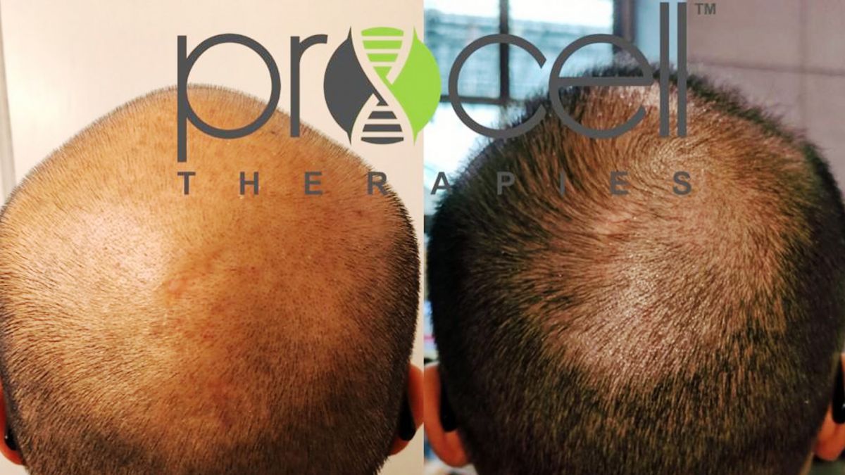 Hair treatment with Procell stem cells