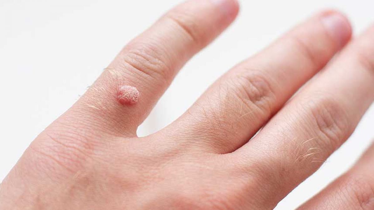 Wart and mole removal plasma pen