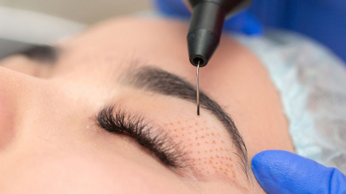 Fibroblast plasma pen treatment